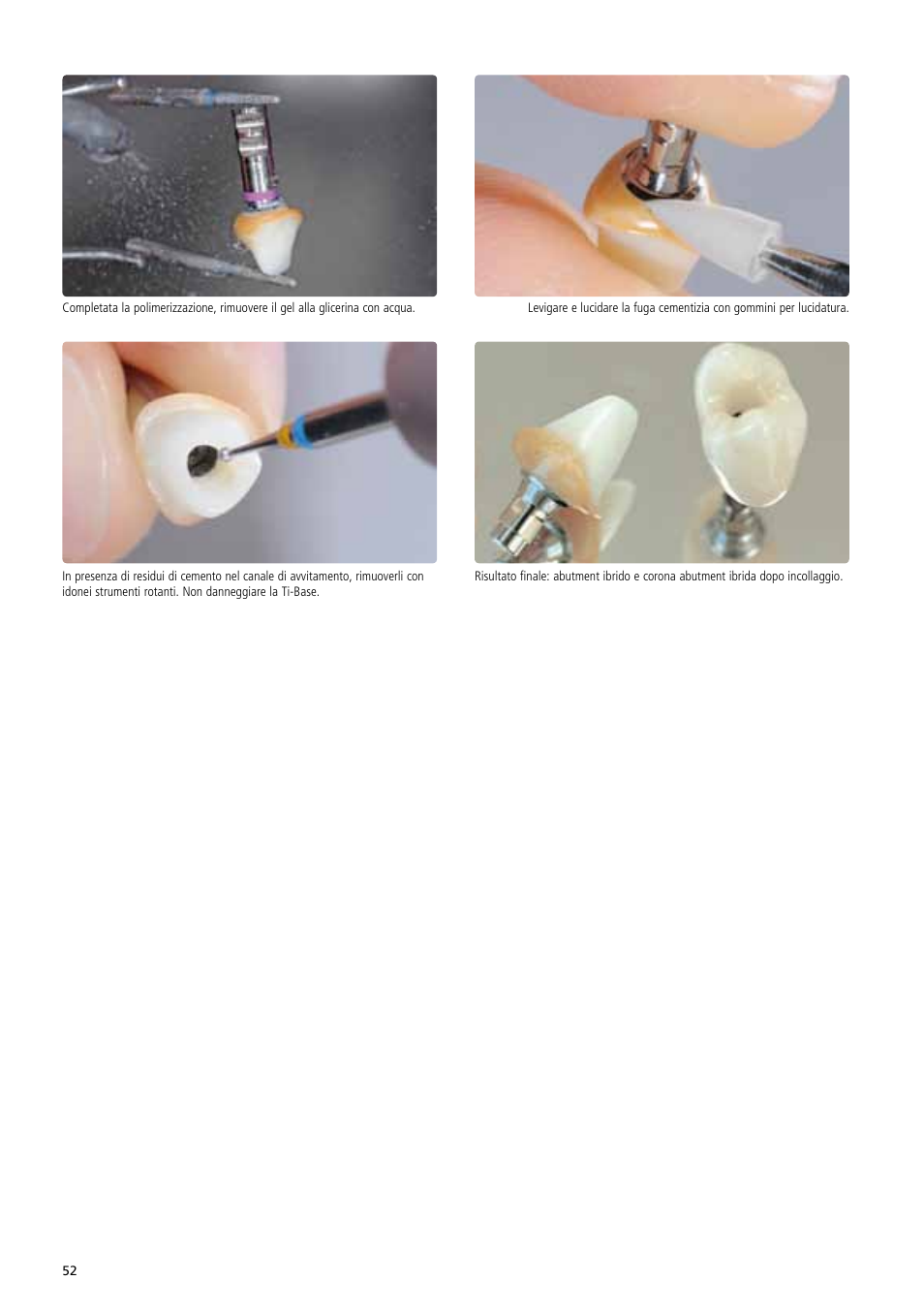 Ivoclar Vivadent IPS e.max Abutment Solutions Cem Kit v.3 User Manual | Page 52 / 80
