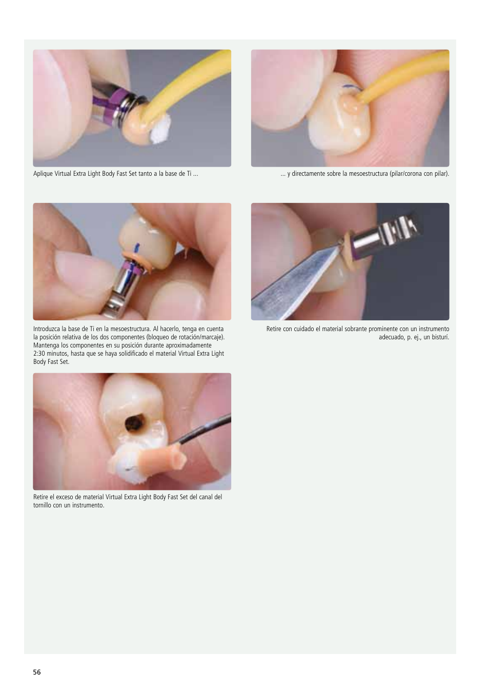 Ivoclar Vivadent IPS e.max Abutment Solutions Cem Kit v.3 User Manual | Page 56 / 80