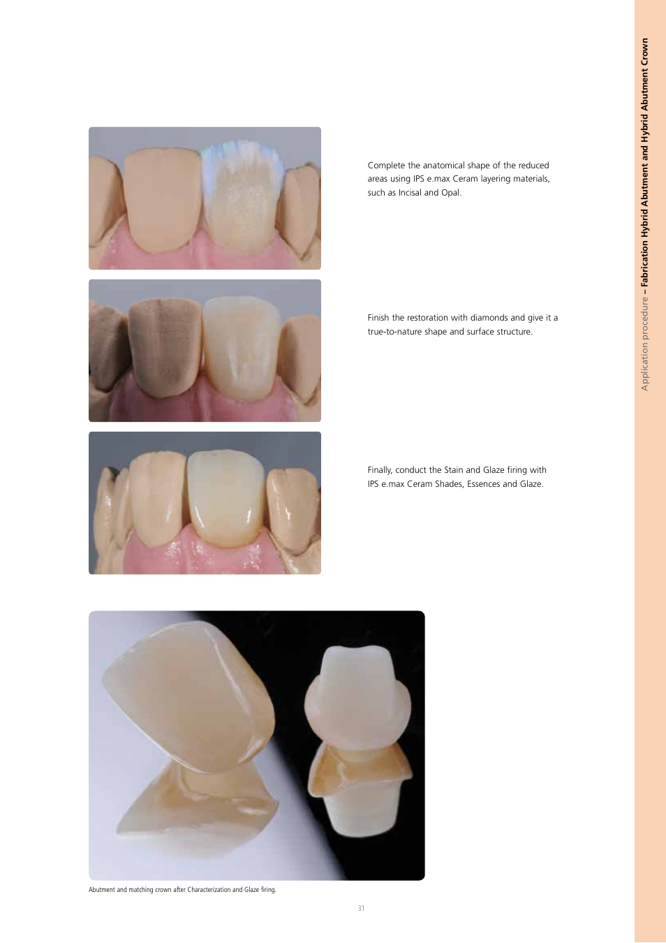 Ivoclar Vivadent IPS e.max Press Abutment Solutions v.2 User Manual | Page 31 / 56