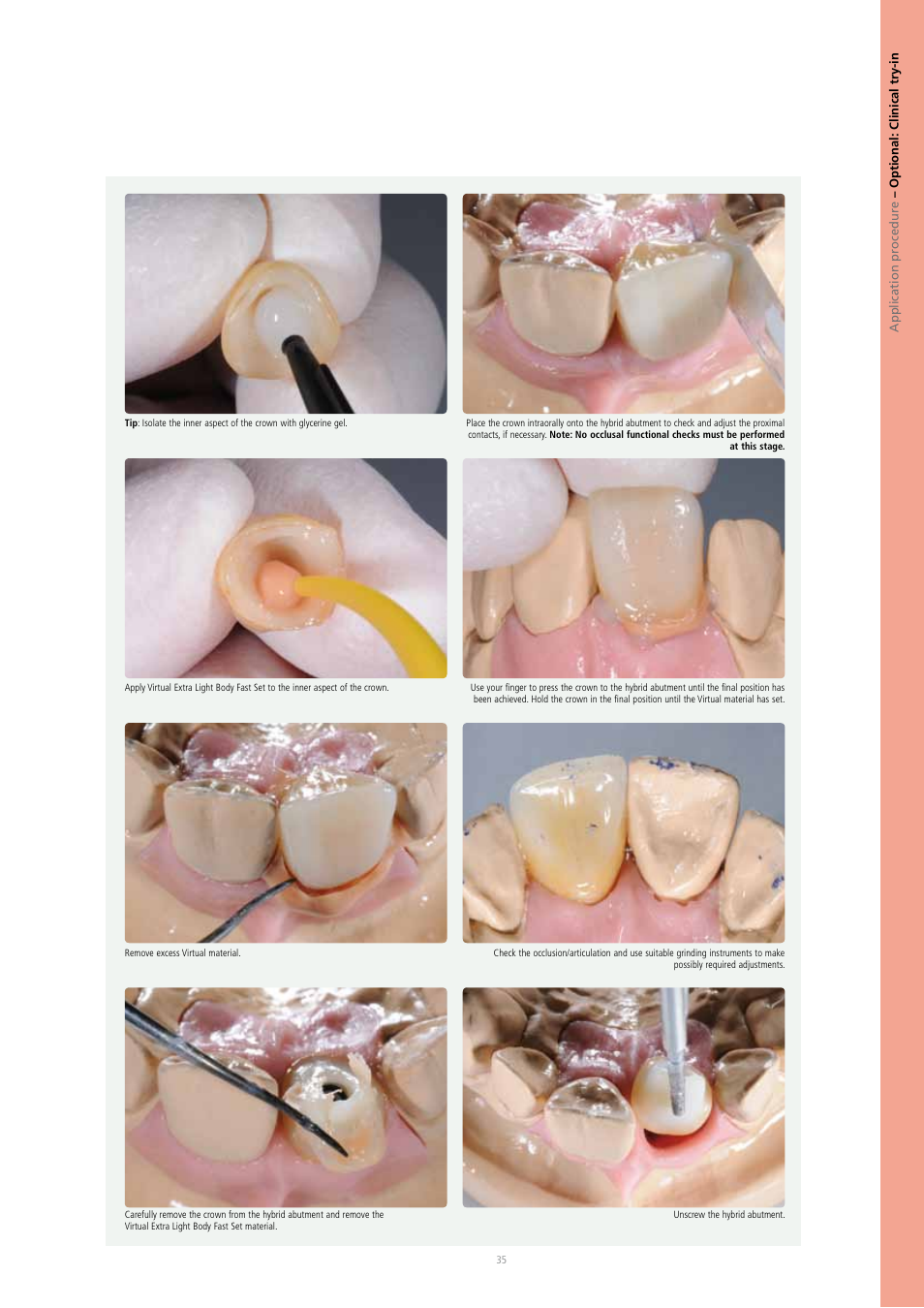 Ivoclar Vivadent IPS e.max Press Abutment Solutions v.2 User Manual | Page 35 / 56