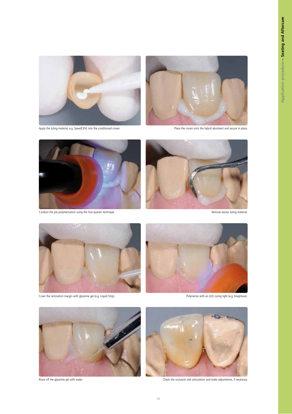 Ivoclar Vivadent IPS e.max Press Abutment Solutions v.2 User Manual | Page 45 / 56