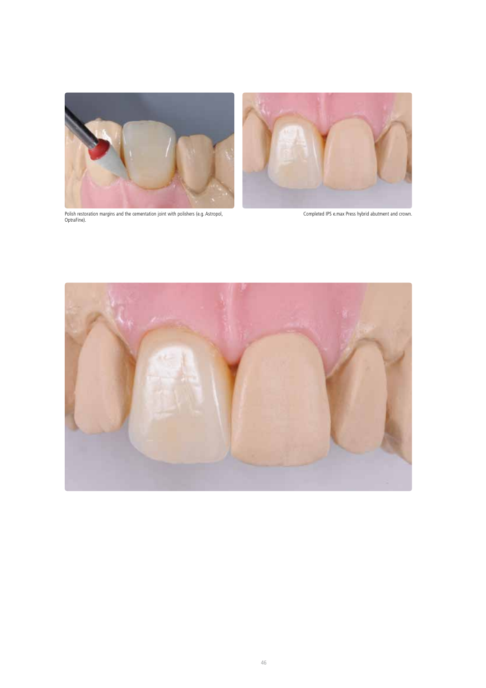 Ivoclar Vivadent IPS e.max Press Abutment Solutions v.2 User Manual | Page 46 / 56